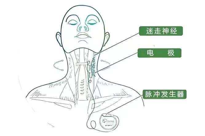 C:/Users/marenyan/Desktop/汪祥伟/汪祥伟/迷走.jpg迷走